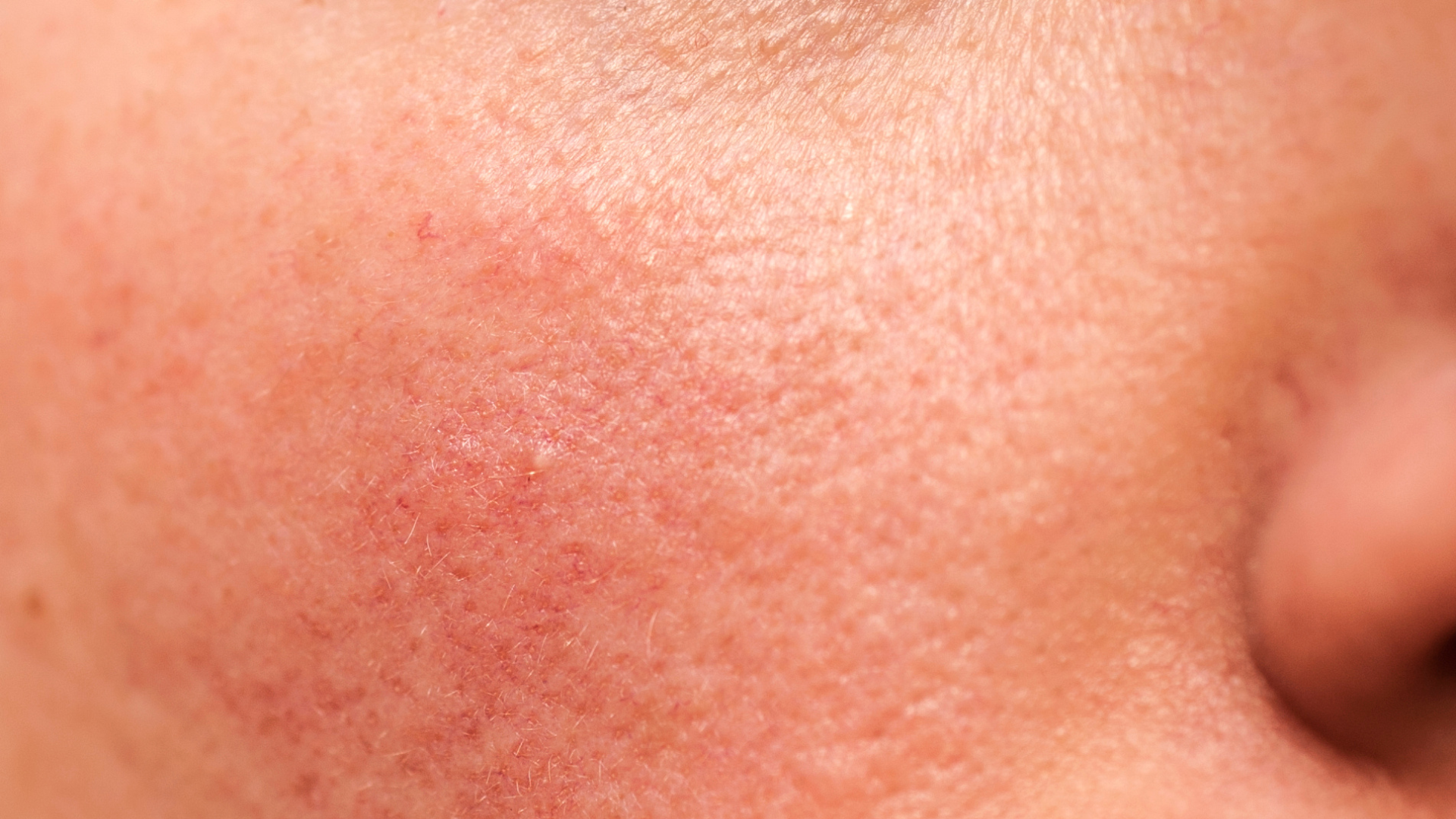 Redness and Rosacea Concerns